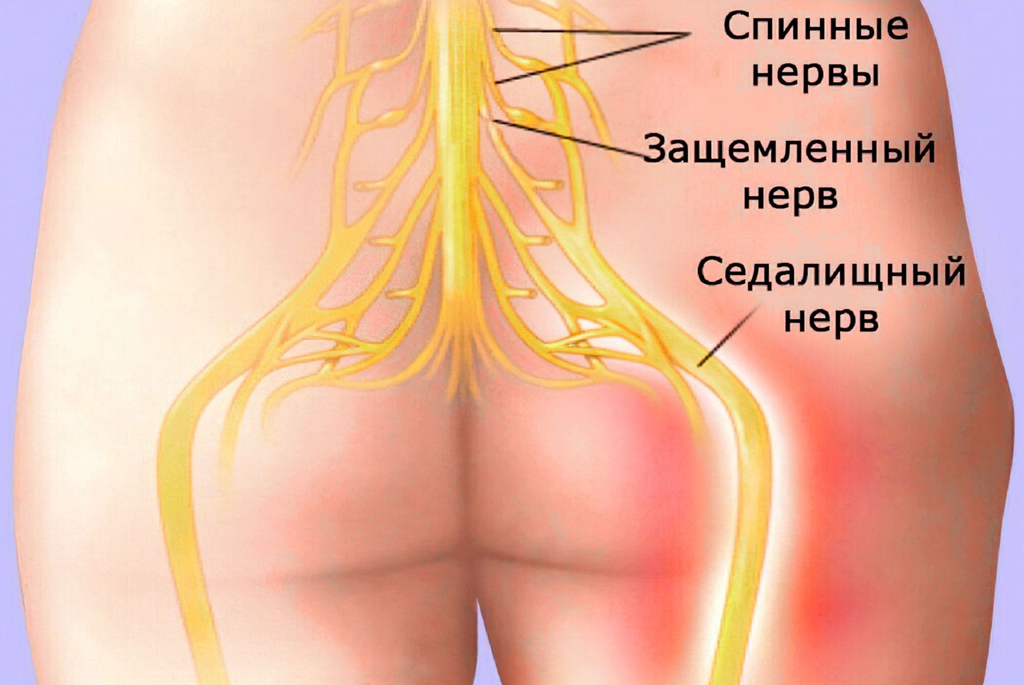 Зажат нерв лечение. Защемление седалищного нерва. Анатомия. Седалищный нерв в ягодице. Седалищный нерв схема.